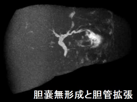 胆嚢無形成と胆管拡張 胆嚢無形成と胆管拡張