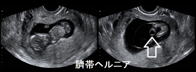 臍帯ヘルニア 臍帯ヘルニア