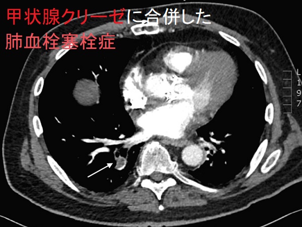 甲状腺クリーゼに肺血栓塞栓症を合併 甲状腺クリーゼに肺血栓塞栓症を合併