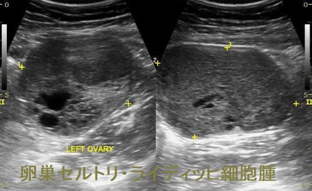 卵巣セルトリ・ライディッヒ細胞腫 超音波(エコー)画像 卵巣セルトリ・ライディッヒ細胞腫 超音波(エコー)画像