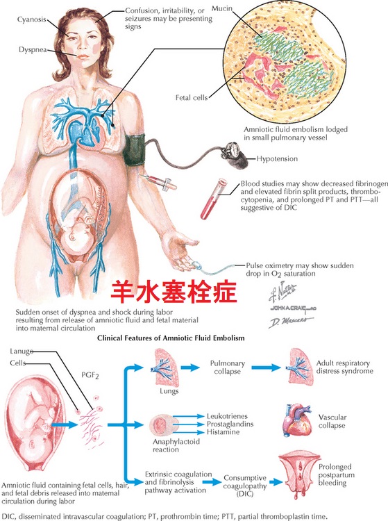肺塞栓症 肺塞栓症
