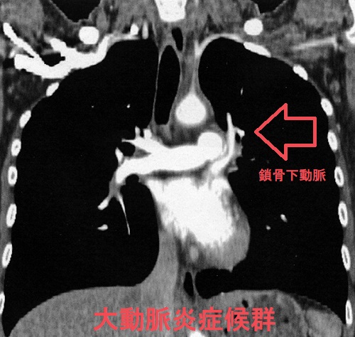 大動脈炎症候群 造影CT 鎖骨下動脈狭窄 大動脈炎症候群 造影CT 鎖骨下動脈狭窄