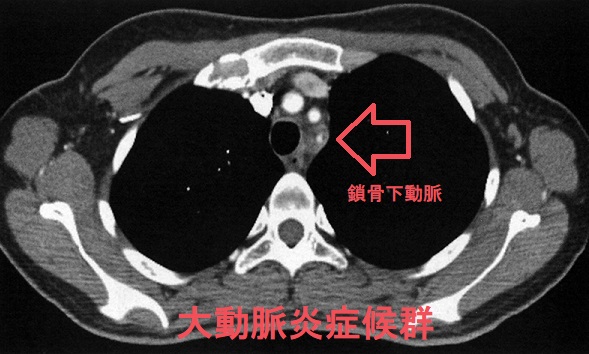 大動脈炎症候群 造影CT 鎖骨下動脈狭窄 大動脈炎症候群 造影CT 鎖骨下動脈狭窄