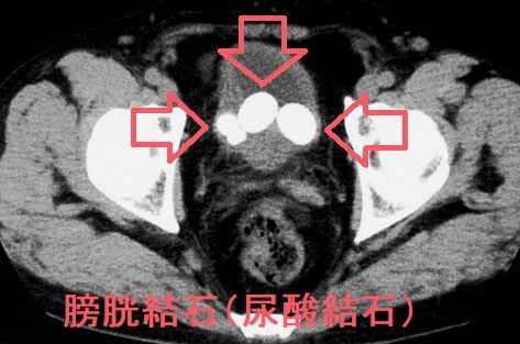 膀胱結石のCT画像 膀胱結石のCT画像