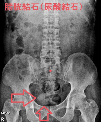 膀胱結石のX線写真 膀胱結石のX線写真