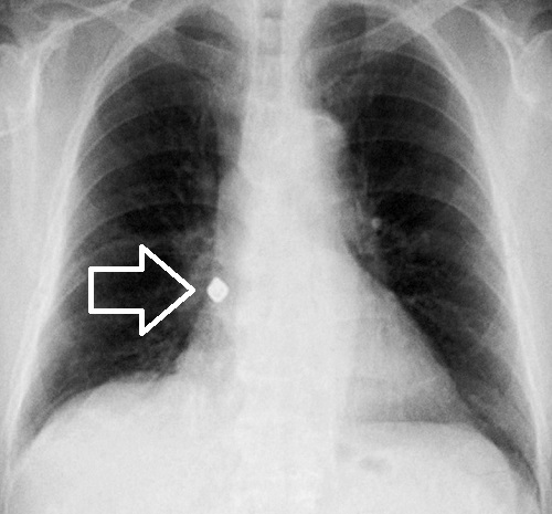 金属製異物(歯冠)による右気管支異物 胸部X線 金属製異物(歯冠)による右気管支異物 胸部X線