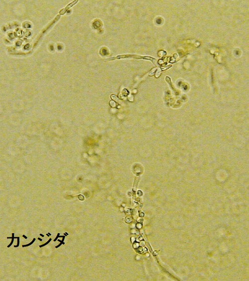 カンジダ膣炎 カンジダ膣炎