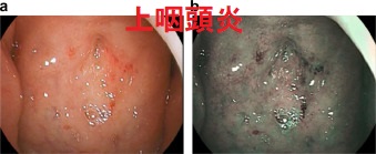 上咽頭炎 上咽頭炎