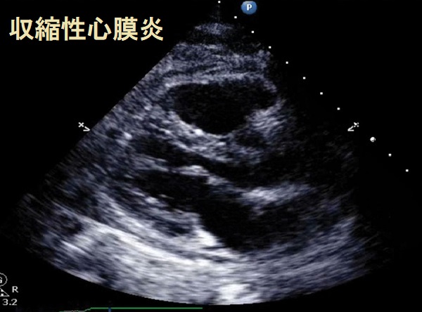 収縮性心膜炎 心エコー 収縮性心膜炎 心エコー