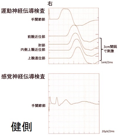 神経伝導検査;肘部管症候群の無い健側 神経伝導検査;肘部管症候群の無い健側