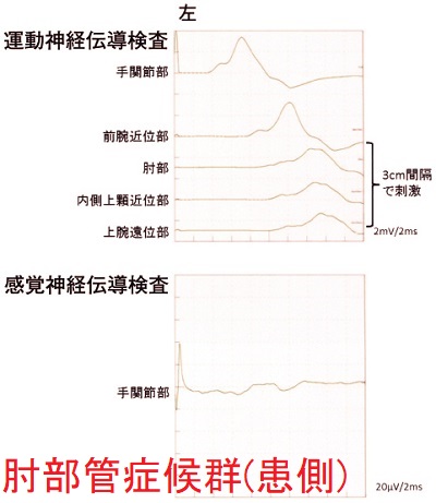 神経伝導検査;肘部管症候群の患側 神経伝導検査;肘部管症候群の患側