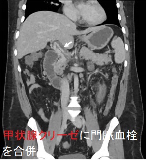 甲状腺クリーゼに肺血栓塞栓症、門脈血栓を合併 甲状腺クリーゼに肺血栓塞栓症、門脈血栓を合併