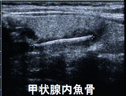 甲状腺内魚骨異物 超音波(エコー)画像 甲状腺内魚骨異物 超音波(エコー)画像