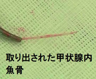 手術で取り出された甲状腺内魚骨異物 手術で取り出された甲状腺内魚骨異物