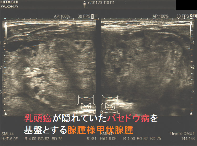 組織レベルで甲状腺乳頭癌が発生した巨大腺腫様甲状腺腫を伴う難治性甲状腺機能亢進症/バセドウ病 組織レベルで甲状腺乳頭癌が発生した巨大腺腫様甲状腺腫を伴う難治性甲状腺機能亢進症/バセドウ病