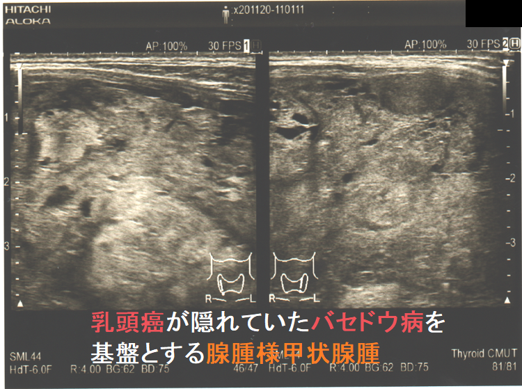組織レベルで甲状腺乳頭癌が発生した巨大腺腫様甲状腺腫を伴う難治性甲状腺機能亢進症/バセドウ病 組織レベルで甲状腺乳頭癌が発生した巨大腺腫様甲状腺腫を伴う難治性甲状腺機能亢進症/バセドウ病