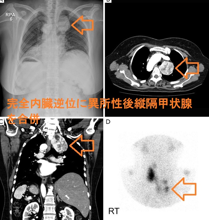 完全内臓逆位に異所性後縦隔甲状腺を合併 完全内臓逆位に異所性後縦隔甲状腺を合併