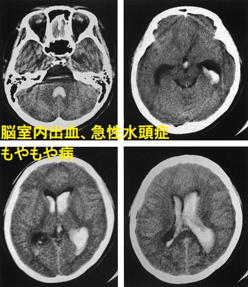 脳室内出血、急性水頭症、もやもや病 脳室内出血、急性水頭症、もやもや病