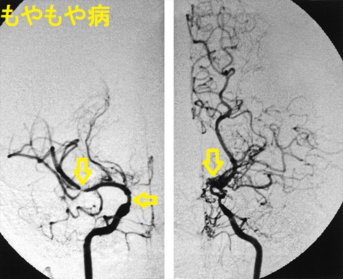 もやもや病 もやもや病