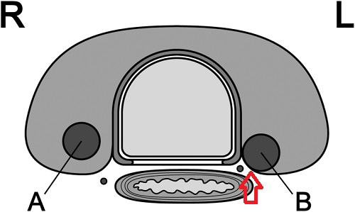 甲状腺微小乳頭癌 反回神経浸潤 甲状腺微小乳頭癌 反回神経浸潤