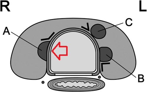 甲状腺微小乳頭癌 気管浸潤 甲状腺微小乳頭癌 気管浸潤