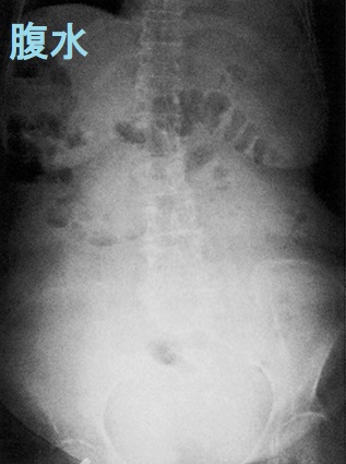 腹水 立位単純X線 腹水 立位単純X線