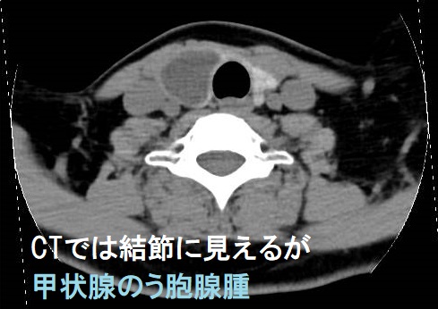 CTでは結節に見えるが甲状腺のう胞腺腫 CT画像 CTでは結節に見えるが甲状腺のう胞腺腫 CT画像