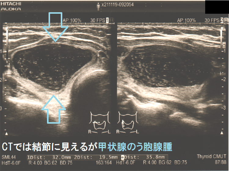 CTでは結節に見えるが甲状腺のう胞腺腫 超音波(エコー)画像 CTでは結節に見えるが甲状腺のう胞腺腫 超音波(エコー)画像