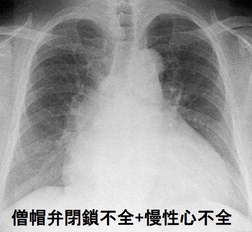 僧帽弁閉鎖不全+慢性心不全 胸部X-p 僧帽弁閉鎖不全+慢性心不全 胸部X-p
