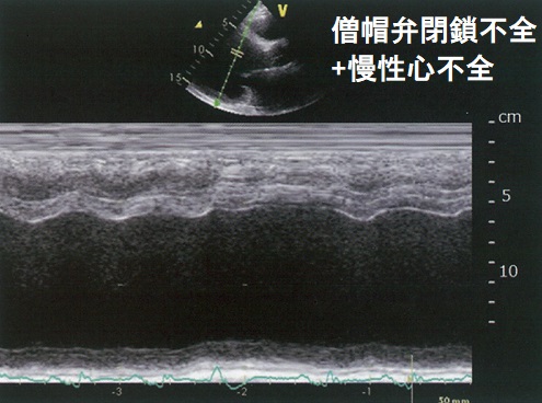 僧帽弁閉鎖不全+慢性心不全 僧帽弁閉鎖不全+慢性心不全 胸部X-p