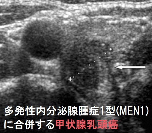 多発性内分泌腺腫症1型(MEN1)に合併する甲状腺乳頭癌 多発性内分泌腺腫症1型(MEN1)に合併する甲状腺乳頭癌