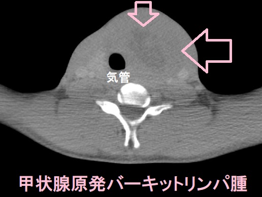 甲状腺原発バーキットリンパ腫 甲状腺原発バーキットリンパ腫