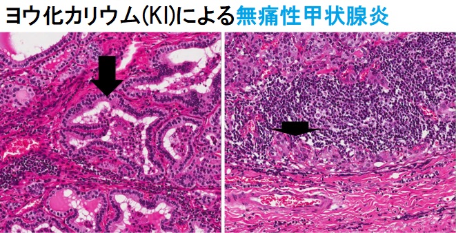ヨウ化カリウム(KI)による無痛性甲状腺炎 ヨウ化カリウム(KI)による無痛性甲状腺炎