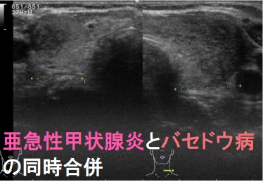 亜急性甲状腺炎とバセドウ病の同時合併 亜急性甲状腺炎とバセドウ病の同時合併