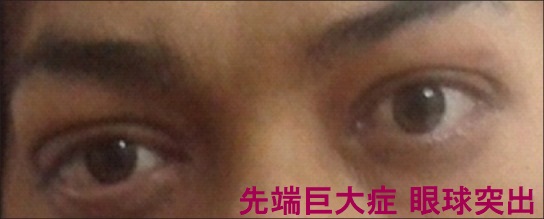 先端巨大症 眼球突出 眼筋肥大、眼瞼腫脹 先端巨大症 眼球突出 眼筋肥大、眼瞼腫脹