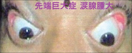 先端巨大症 眼球突出 涙腺腫大 先端巨大症 眼球突出 涙腺腫大