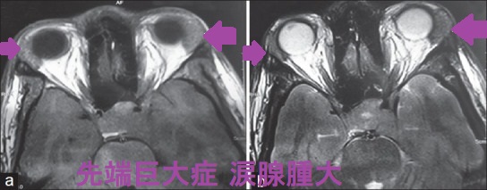 先端巨大症 眼球突出 涙腺腫大 MRI画像 先端巨大症 眼球突出 涙腺腫大 MRI画像