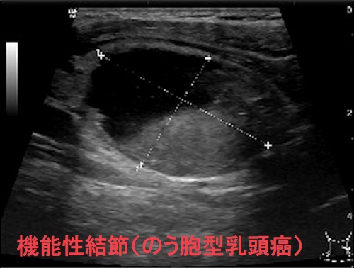 機能性結節(のう胞型乳頭癌) 機能性結節(のう胞型乳頭癌)