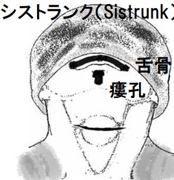 瘻孔 瘻孔