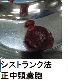 シストランク法 正中頸嚢胞 シストランク法 正中頸嚢胞