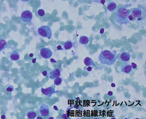甲状腺ランゲルハンス細胞組織球症 細胞診 甲状腺ランゲルハンス細胞組織球症 細胞診