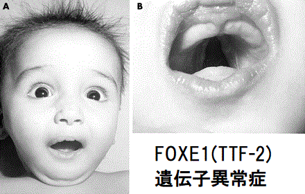 FOXE1(TTF-2)遺伝子異常症 FOXE1(TTF-2)遺伝子異常症