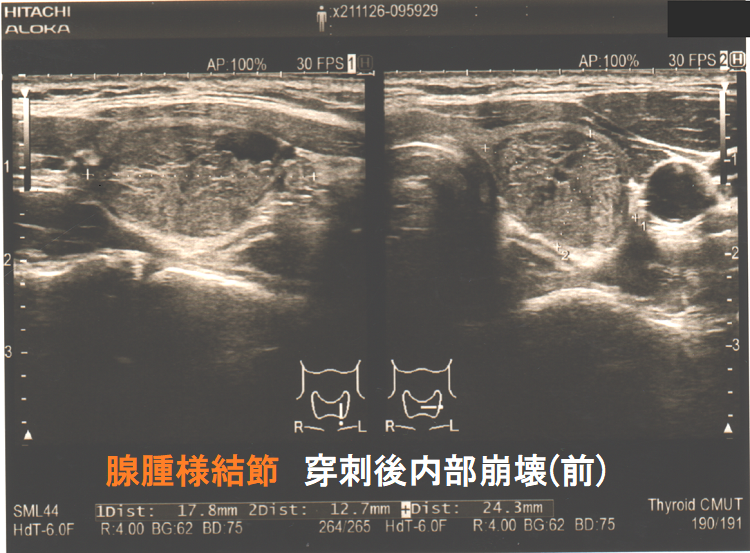 穿刺後内部崩壊 穿刺後内部崩壊 超音波(エコー)画像(穿刺前) 穿刺後内部崩壊 穿刺後内部崩壊 超音波(エコー)画像(穿刺前)