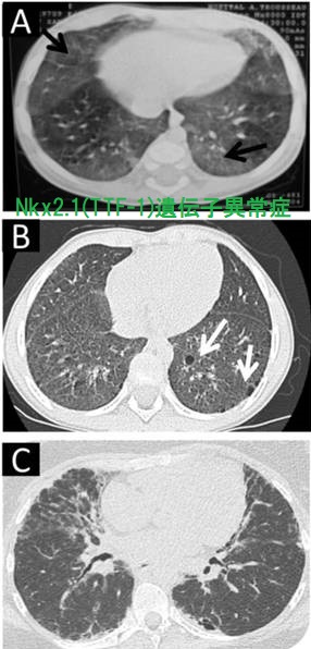 Nkx2.1(TTF-1)遺伝子異常症(Brain-Lung-Thyroid syndrome) Nkx2.1(TTF-1)遺伝子異常症(Brain-Lung-Thyroid syndrome)