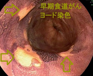 早期食道がん ヨード染色 早期食道がん ヨード染色