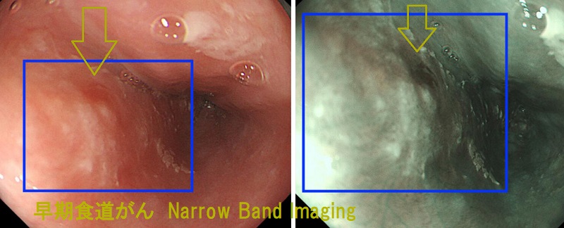 早期食道がん Narrow Band Imaging 早期食道がん Narrow Band Imaging