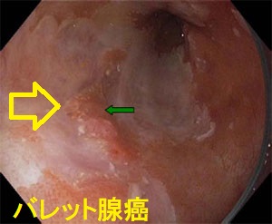 食道癌と甲状腺、甲状腺癌と食道[橋本病 バセドウ病 甲状腺超