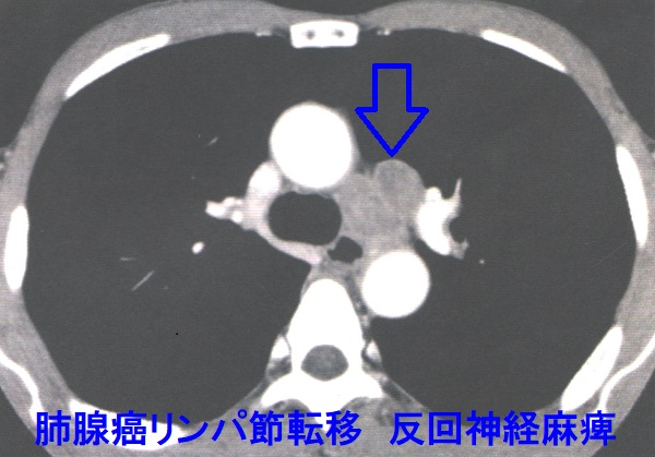 肺腺癌リンパ節転移 反回神経麻痺 肺腺癌リンパ節転移 反回神経麻痺
