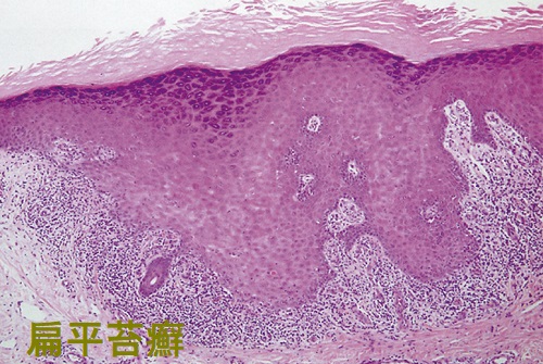 扁平苔癬 病理組織像 扁平苔癬 病理組織像