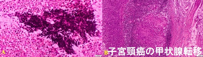子宮頸癌の甲状腺転移(転移性甲状腺がん) 子宮頸癌の甲状腺転移(転移性甲状腺がん)